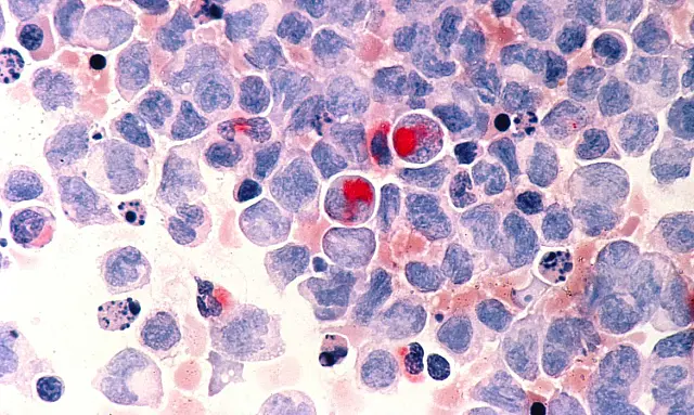 Mortalidade prematura por câncer no Brasil deve cair até 2030
