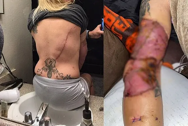 Pitbull avança contra dona e arranca pedaço do braço