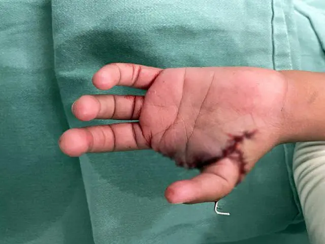 Criança ganha polegar após cirurgia de transplante