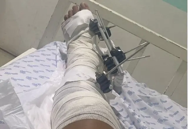 Acidente: Passageira de moto ainda não tem previsão de alta