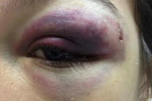 Homem joga copo no rosto de mulher e desloca globo ocular dela, em Anastácio