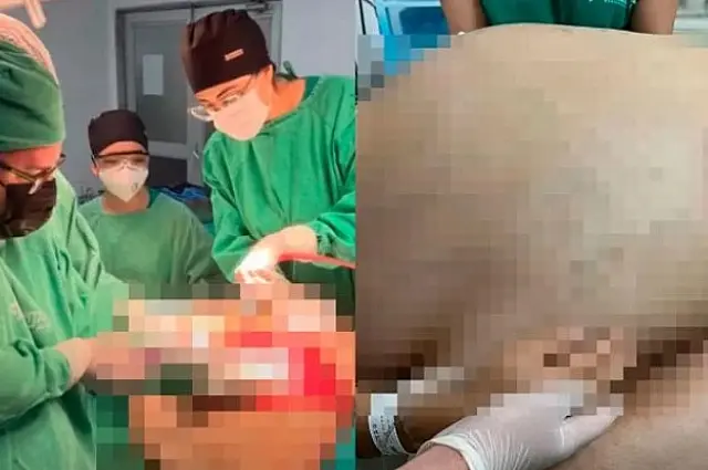 Médico tira tumor de 46 kg em cirurgia de emergência no Rio