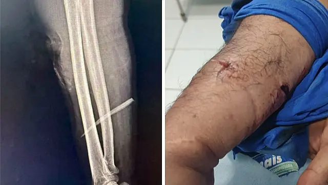 Pescador atingido por ferrão de peixe no rio Aquidauana passa por cirurgia