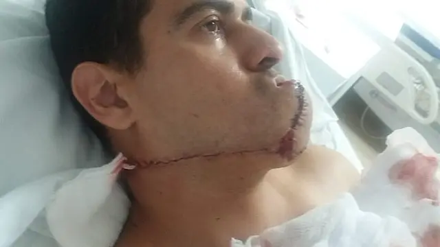 Policial atacado por pit bull ganha tratamento avaliado em R$ 60 mil e passa por duas cirurgias em MS