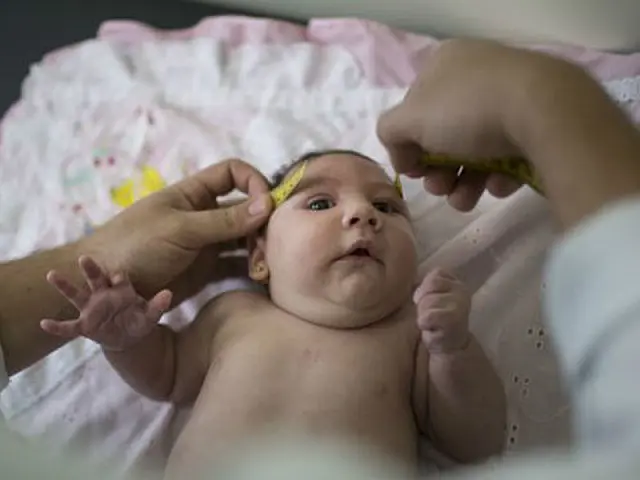 Brasil investiga 3.935 casos suspeitos de microcefalia
