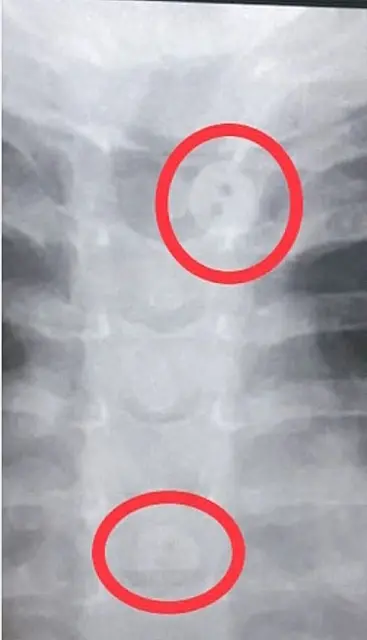 Criança vai parar no pronto-socorro após fazer raio-x vestida e médico achar que ela tinha engolido botões da camisa