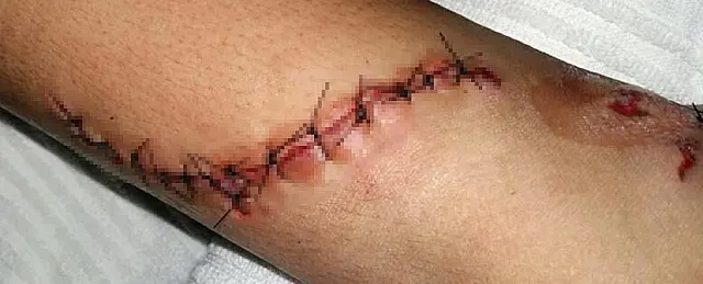 Menino é atacado por jacaré ao atravessar lagoa e sofre corte de 12 centímetros no tornozelo