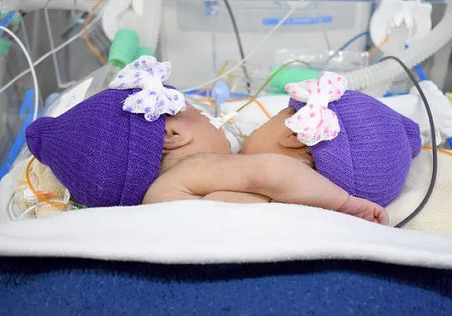 Gêmeas permanecem internadas sem previsão de cirurgia