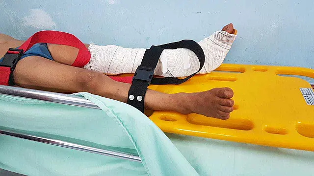 Ao brincar, criança sofre fratura grave na tíbia e deve passar hoje por cirurgia