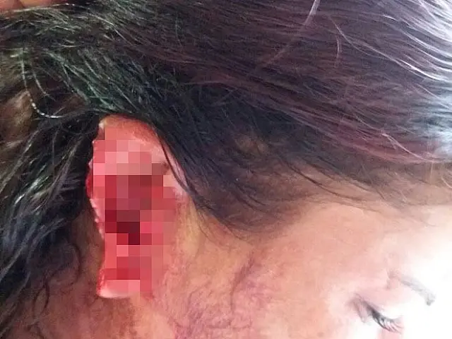 Mulher arranca parte da orelha de amante do marido com mordida