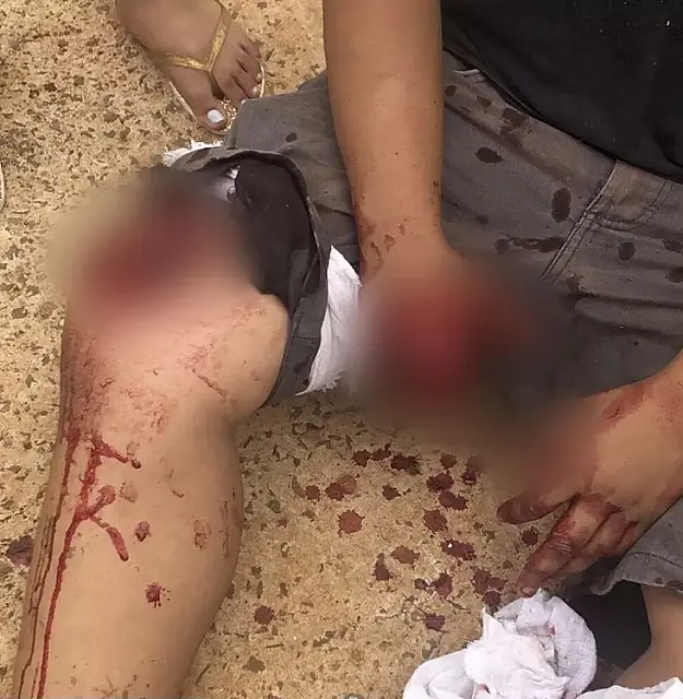 Ao manusear fogos, adolescente perde dois dedos da mão