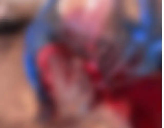 Jovem fica gravemente ferido após cair de caminhão em Aquidauana