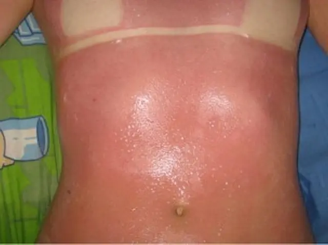 MS: bronzeamento 'natural' acaba em queimadura