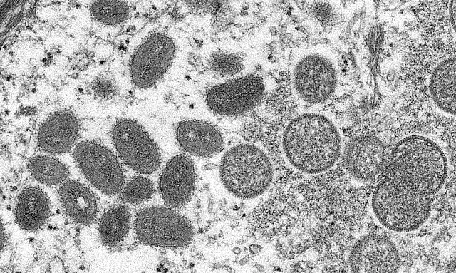 Saúde em MS monitora sete casos suspeitos de varíola dos macacos