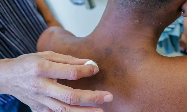 Pandemia faz notificações de hanseníase caírem 57%