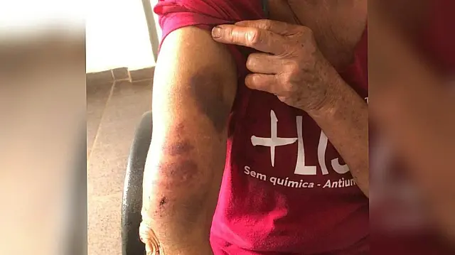 Mulher é salva por policial após marido jogar óleo fervente em seu corpo