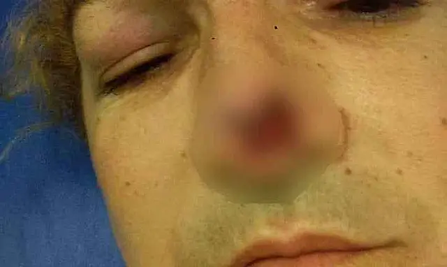 Mulher trans é brutalmente espancada por parceiro e tem parte do nariz arrancado
