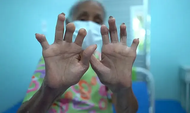 Hanseníase: pacientes contam histórias de preconceito e superação