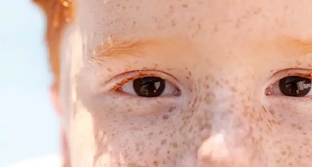 Campanha de conscientização sobre retinoblastoma começa hoje