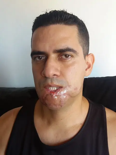 Policial diz que 'agradece a Deus por estar vivo' após ataque de pitbull