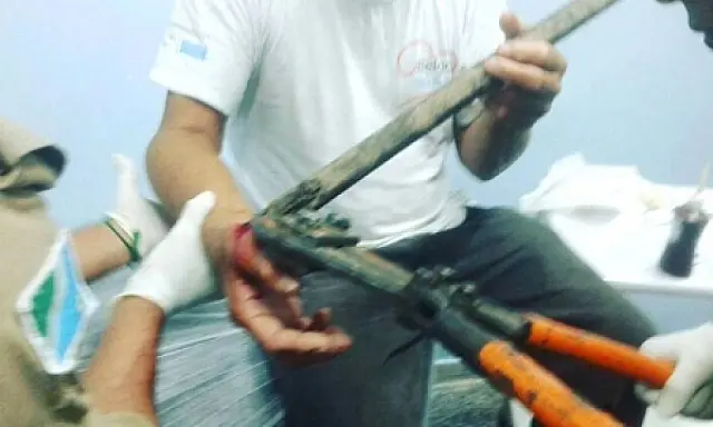 Bombeiros e médicos retiram gancho da mão de paciente