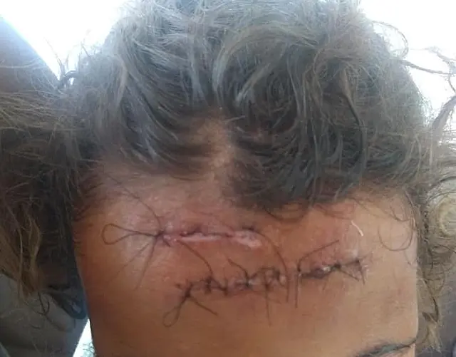 Criança teria espancado menina de três anos e quebrado braços dela na Capital